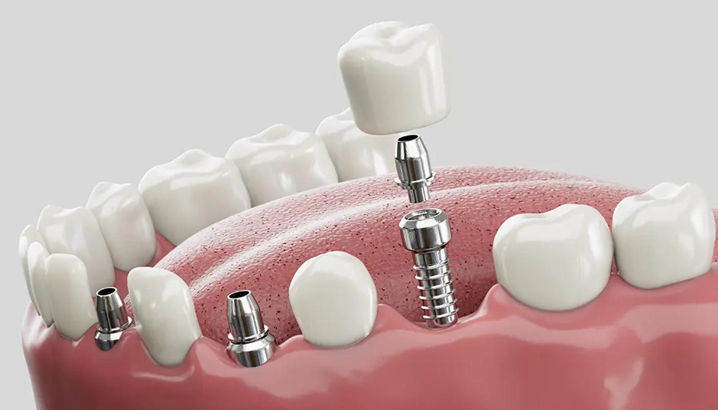 implantologia dentale